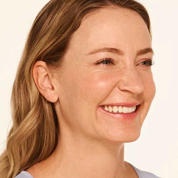 Mandy at full smile before BOTOX® Cosmetic, showing crow’s feet lines