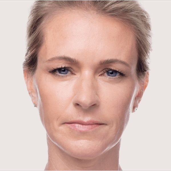 Deven frowning 33 days after Dysport®, with softer frown lines