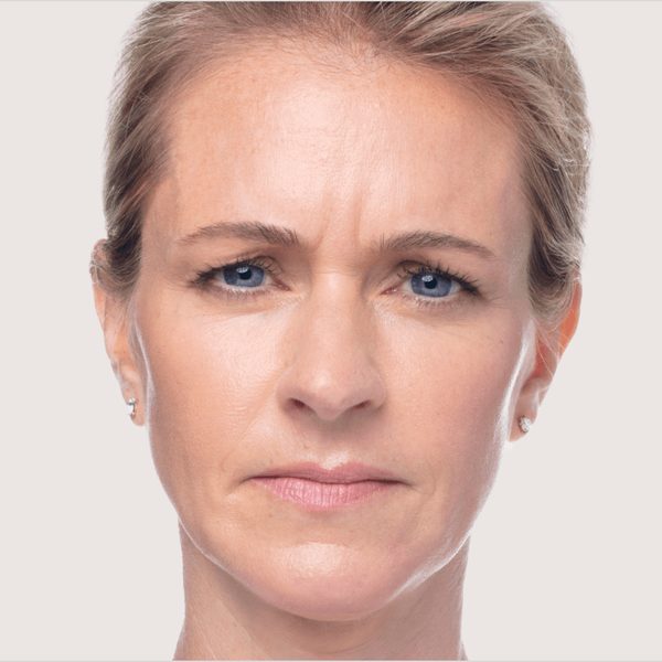 Deven frowning before Dysport®, showing frown lines between the brows