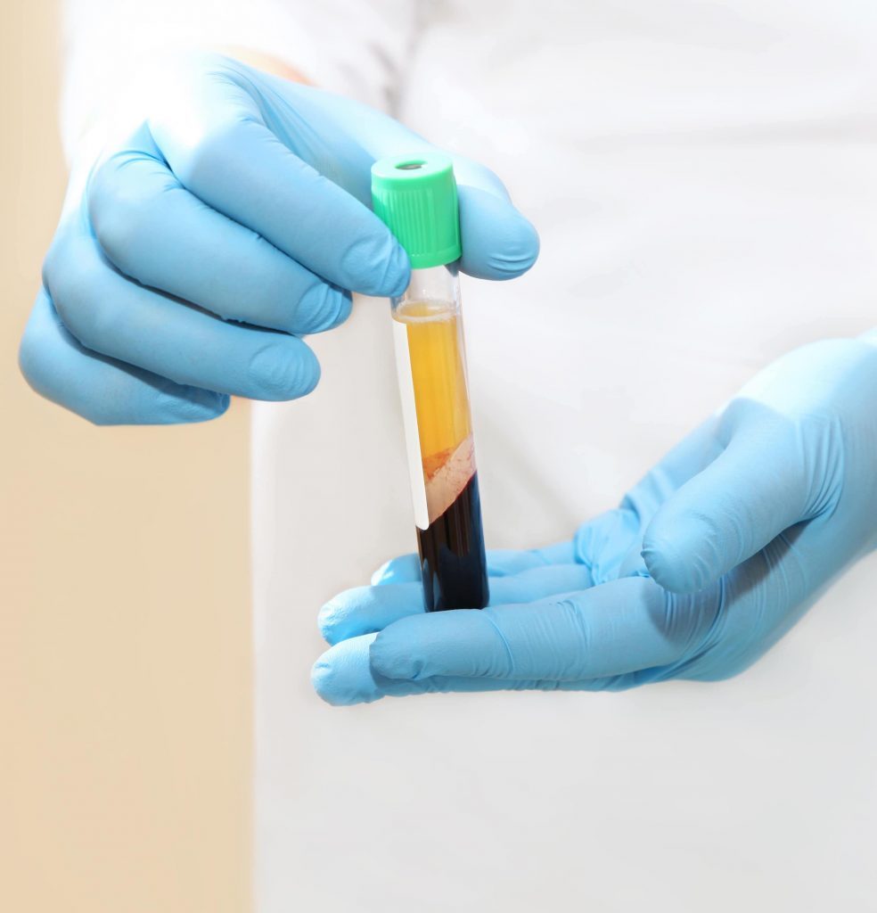 Doctor's hands holding a vial of PRP serum