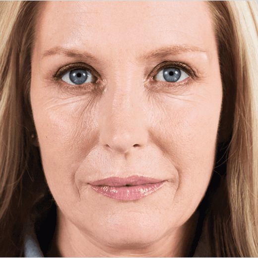 Elissa before Sculptra® treatment, front view