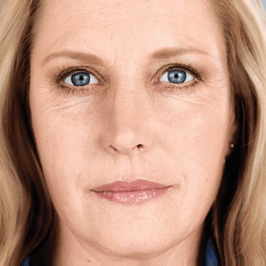 Elissa 25 months after treatment with Sculptra®