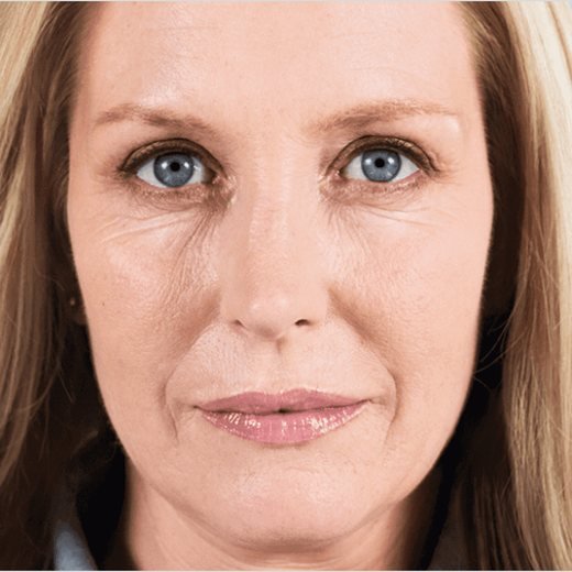 Elissa before Sculptra® treatment, front view