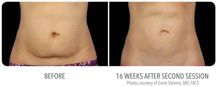 CoolSculpting front abdomen before and 16 weeks after second session