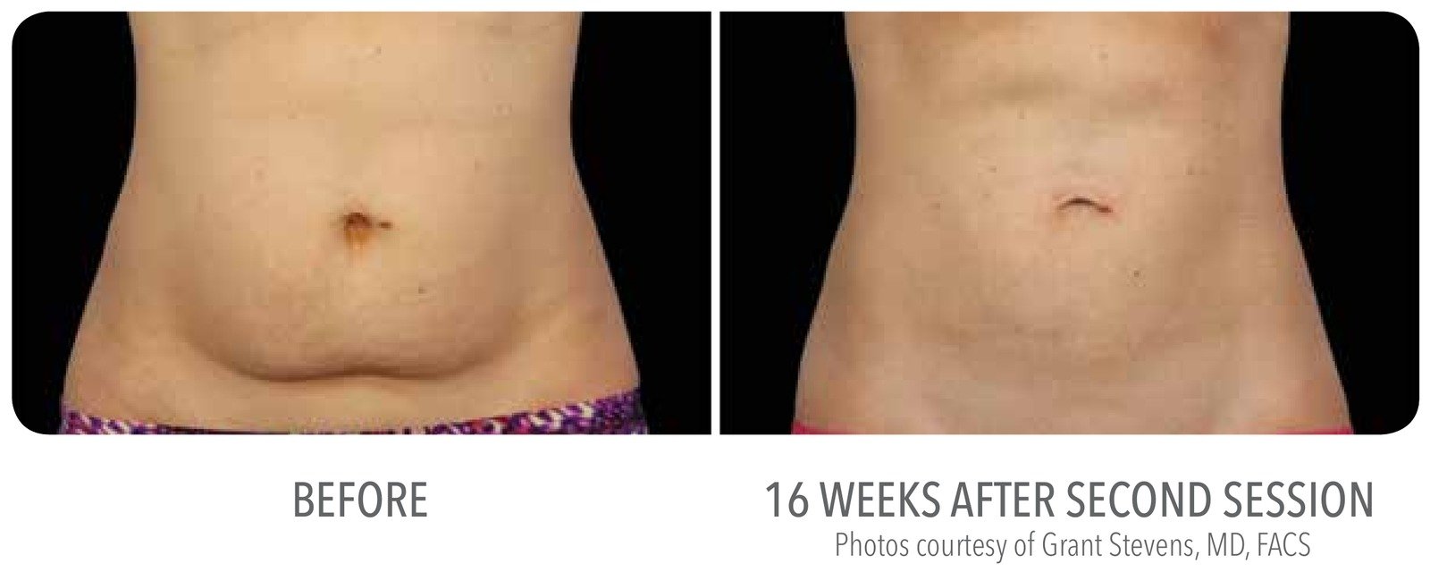 CoolSculpting front abdomen before and 16 weeks after second session
